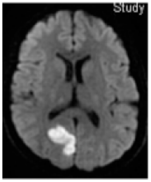 Prevalencia de Migraña