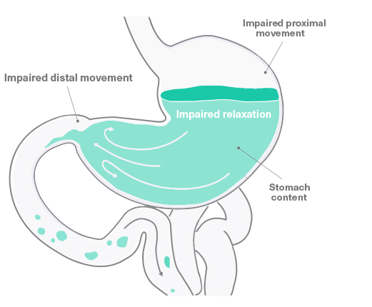 duodopa-en-section7-image3-ALL-DUOD-200035-abbviepro
