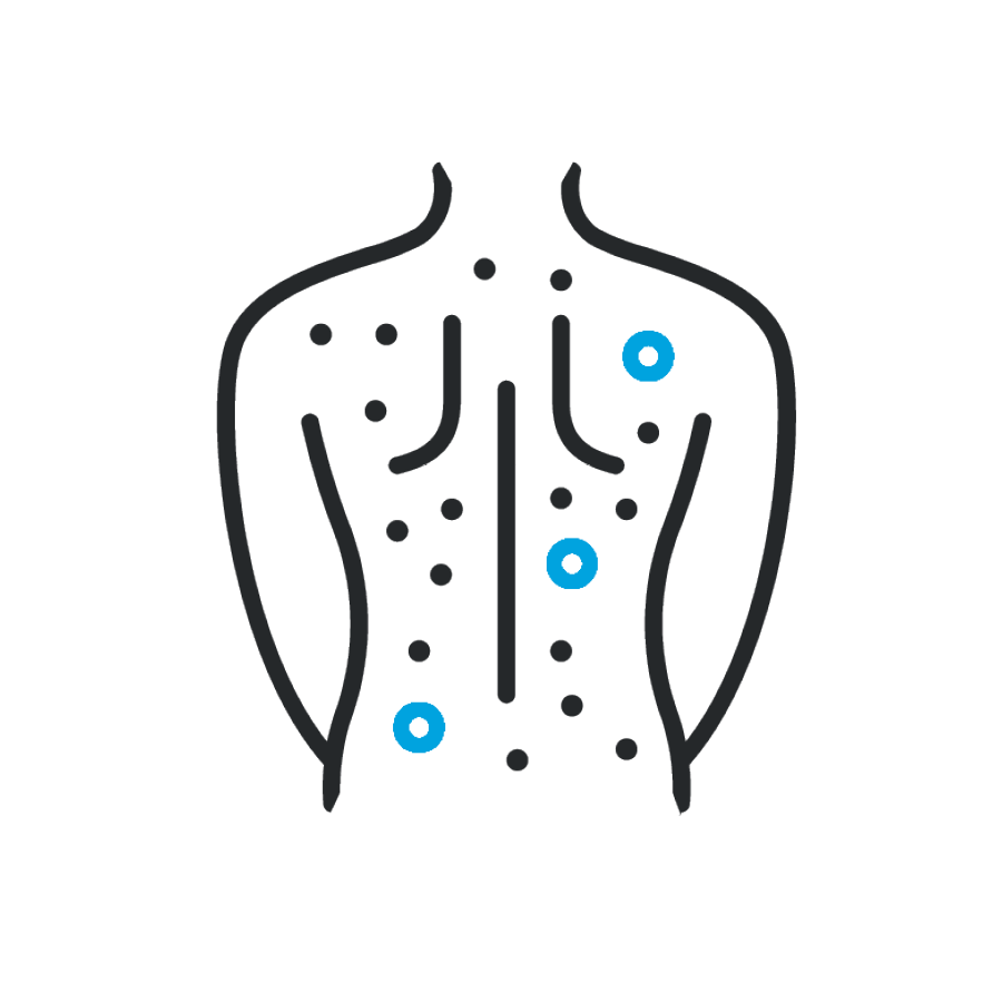 Visuals eines Rückens mit Punkten, die Entzünden darstellen sollen