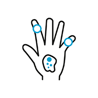 Visual vo einer Hand. Darauf blaue Hervorhebungen, die rheumatische Beschwerden symbolisieren sollen
