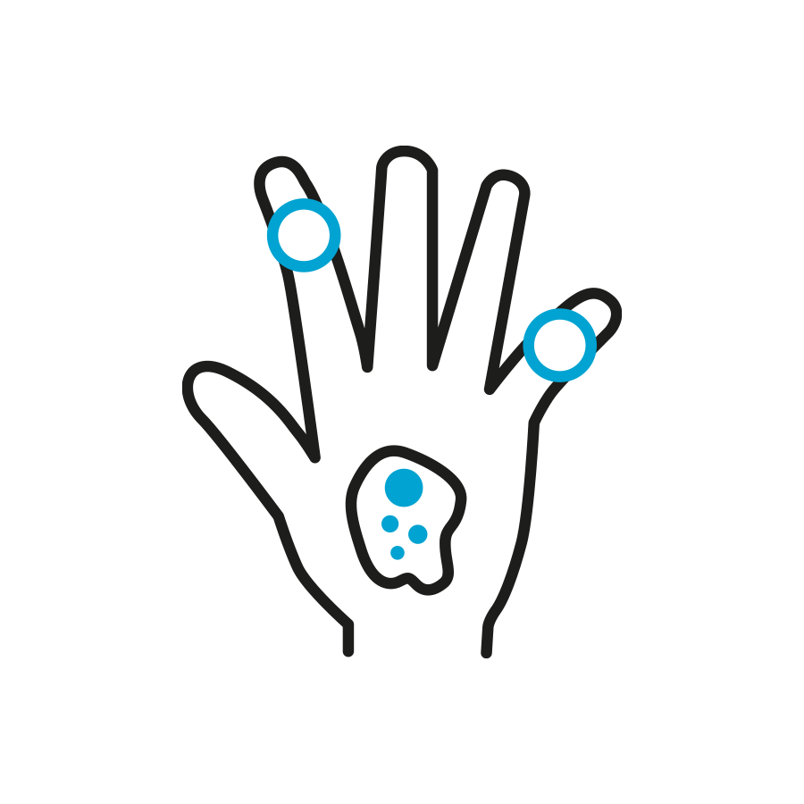 Visual vo einer Hand. Darauf blaue Hervorhebungen, die rheumatische Beschwerden symbolisieren sollen