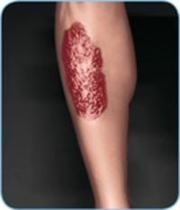 Typisches Hautbild bei Pyoderma gangraenosum