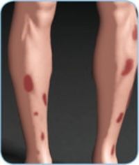 Typisches Hautbild bei Erythema nodosum 