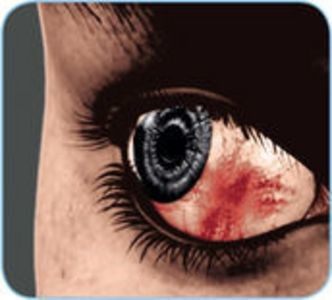 Bei einer Episkleritis ist das betroffene Auge meist rötlich entzündet, geschwollen und gereizt.  