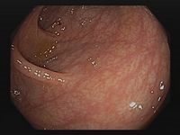 Endoskopie bei Verdacht auf Colitis ulcerosa: normaler Befund, inaktive Erkrankung