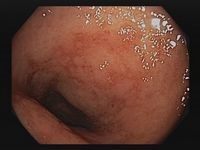 Endoskopie bei Colitis ulceorsa: leichte Erkrankung 