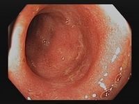 Endoskopie bei Colitis ulceorsa: mittelschwere Erkrankung