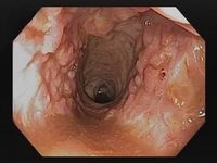 Endoskopie bei Colitis ulceorsa: schwere Erkrankung