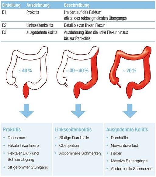 Ausprägungsformen der Colitis ulcerosa