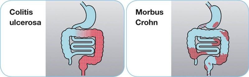 Befallsmuster bei Colitis ulcerosa und Morbus Crohn