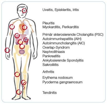 Die Grafik zeigt verschiedene Krankheitsbilder, die als extraintestinale Manifestationen des Morbus Crohn auftreten können.   Die Grafik zeigt verschiedene Krankheitsbilder, die als extraintestinale Manifestationen des Morbus Crohn auftreten können.
