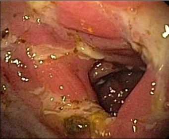 Endzündete Mukosa bei Morbus Crohn (Aufnahme per Endoskopie) Endzündete Mukosa bei Morbus Crohn (Aufnahme per Endoskopie)