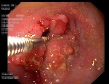 Darmstenose bei Morbus Crohn (Aufnahme per Endoskopie)  Darmstenose bei Morbus Crohn (Aufnahme per Endoskopie)