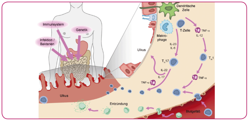 Bei Menschen mit Morbus Crohn lösen verschiedene Immunzellen und Botenstoffe eine anhaltende Entzündung des Darm aus. Bei Menschen mit Morbus Crohn lösen verschiedene Immunzellen und Botenstoffe eine anhaltende Entzündung des Darm aus.