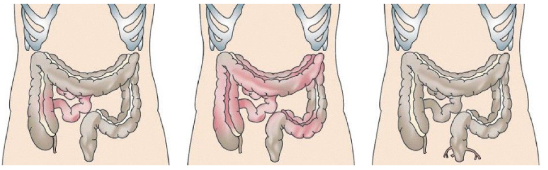 Verschiedene Befallsmuster des Morbus Crohn (Ileitis, Ileokolitis, Morbus Crohn mit Fistelbildung).    Verschiedene Befallsmuster des Morbus Crohn (Ileitis, Ileokolitis, Morbus Crohn mit Fistelbildung).