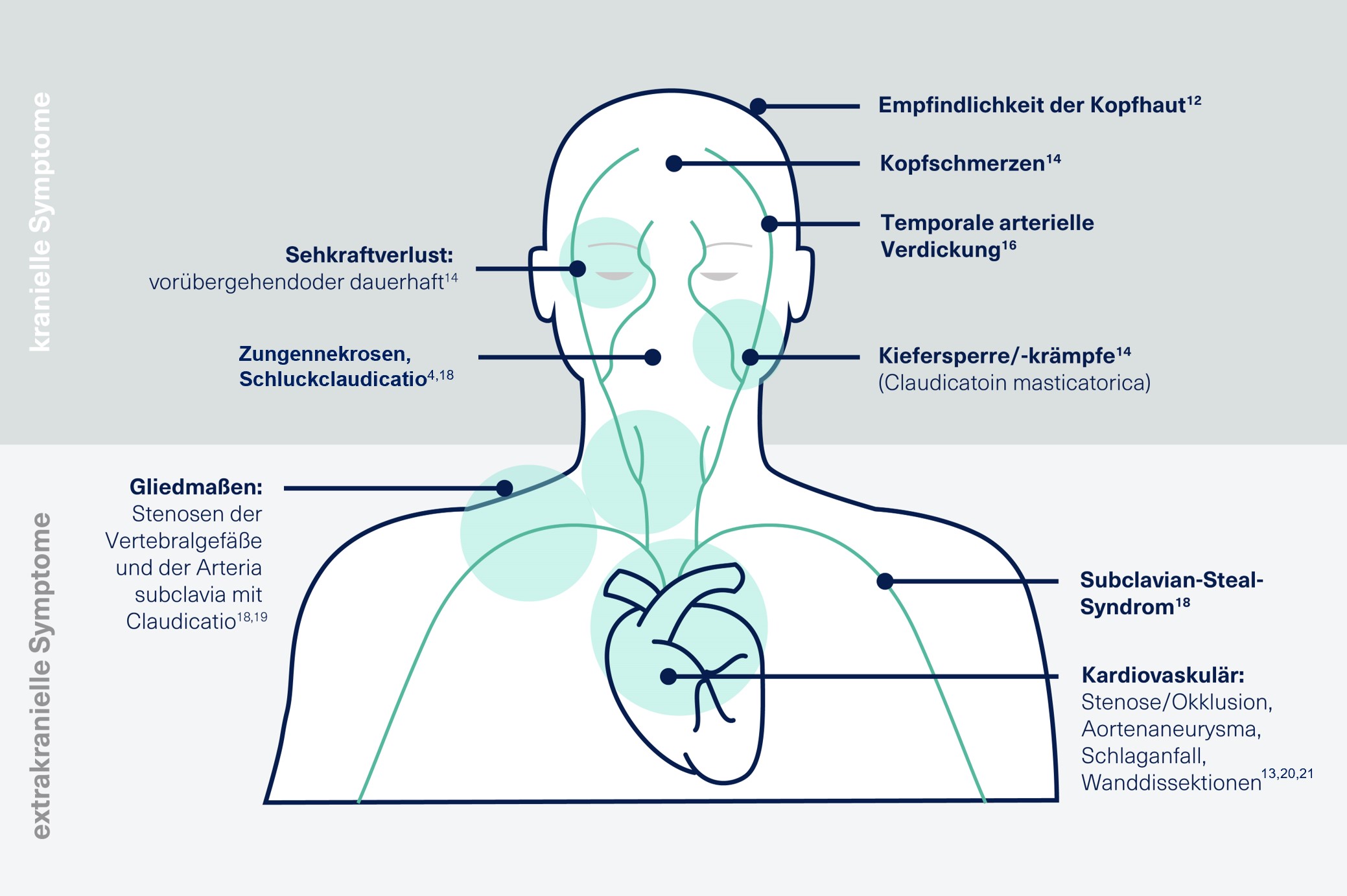 Vielseitige Symptome der Riesenzellarteriitis mit kranieller, extrakranieller oder systemischen Beteiligung Vielseitige Symptome der Riesenzellarteriitis mit kranieller, extrakranieller oder systemischen Beteiligung