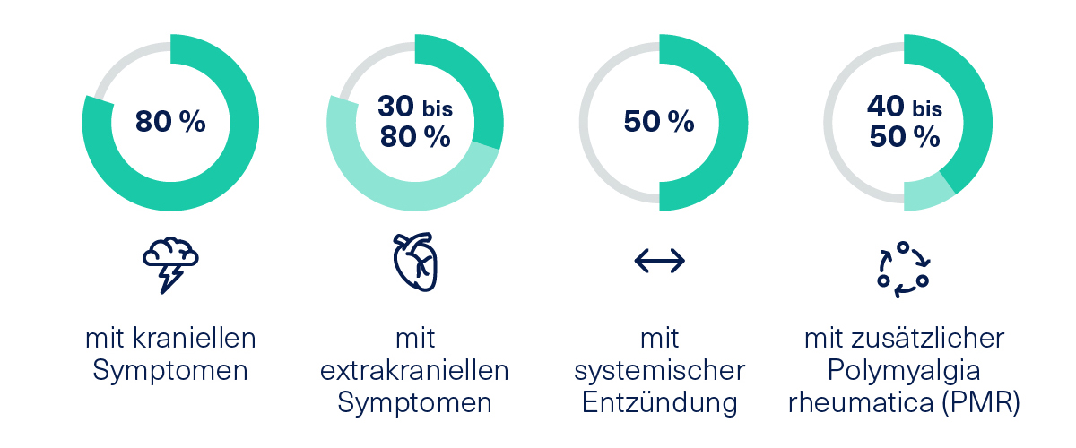 Die Symptome der Riesenzellarteriitis können kraniell, extrakraniell, systemisch oder Polymyalgia rheumatica-assoziiert sein. Die Symptome der Riesenzellarteriitis können kraniell, extrakraniell, systemisch oder Polymyalgia rheumatica-assoziiert sein.