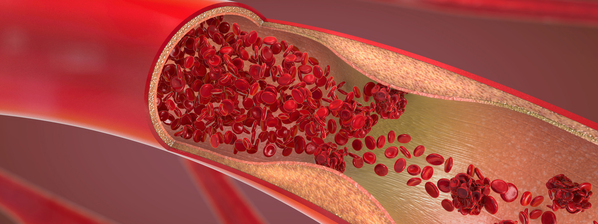 verengte Arterie verengte Arterie