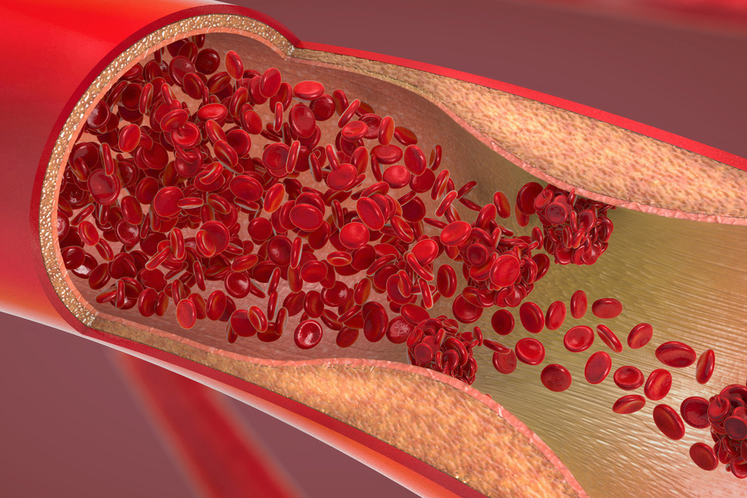 verengte Arterie verengte Arterie