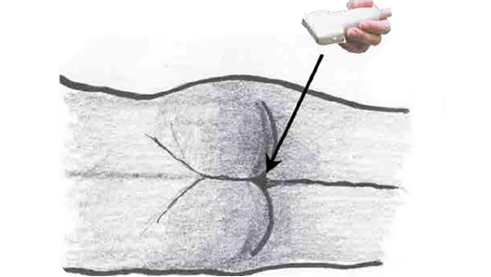 ECHO-MICI-FR-GASTRO-ECHO-COMPLEMENTAIRE-IMG6-ABBVIEPRO