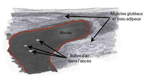 ECHO-MICI-FR-GASTRO-ECHO-COMPLEMENTAIRE-IMG7-ABBVIEPRO