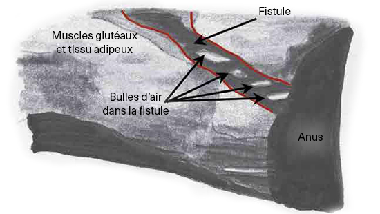 ECHO-MICI-FR-GASTRO-ECHO-COMPLEMENTAIRE-IMG9-ABBVIEPRO