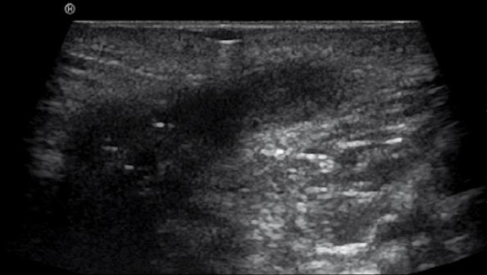 ECHO-MICI-FR-GASTRO-ECHO-COMPLEMENTAIRE-IMG8-ABBVIEPRO