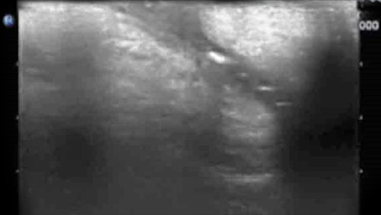 ECHO-MICI-FR-GASTRO-ECHO-COMPLEMENTAIRE-IMG10-ABBVIEPRO