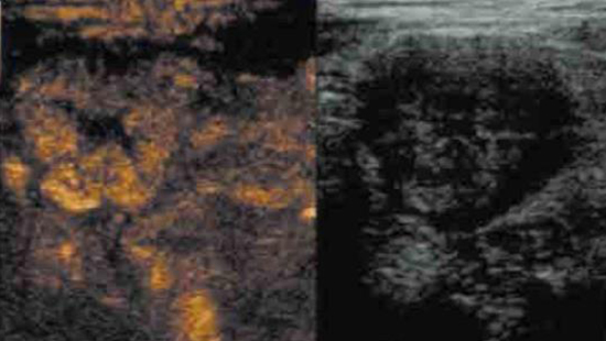 ECHO-MICI-FR-GASTRO-ECHO-COMPLEMENTAIRE-IMG2-ABBVIEPRO