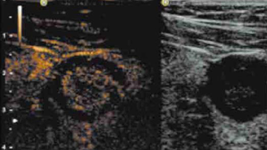 ECHO-MICI-FR-GASTRO-ECHO-COMPLEMENTAIRE-IMG3-ABBVIEPRO