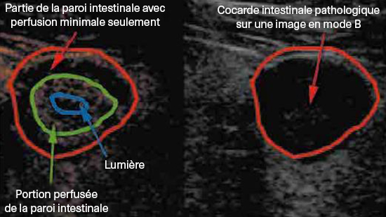 ECHO-MICI-FR-GASTRO-ECHO-COMPLEMENTAIRE-IMG4-ABBVIEPRO