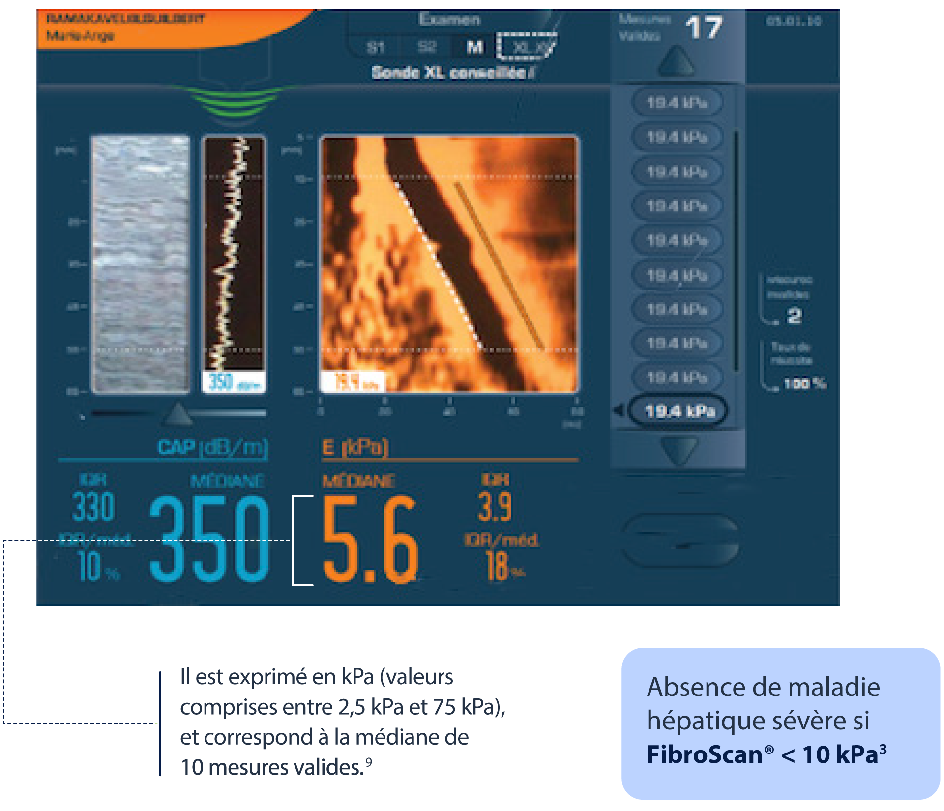PRISE_EN_CHARGE_VHC_FR_VIRO_BILAN_FIBROSCAN2_ABBVIEPRO