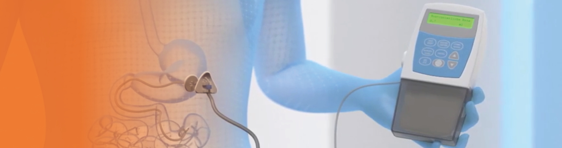 duodopa-en-section4-image3-ALL-DUOD-200035-abbviepro1