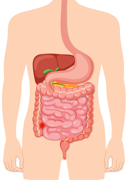 illustrazione L1 ileo terminale