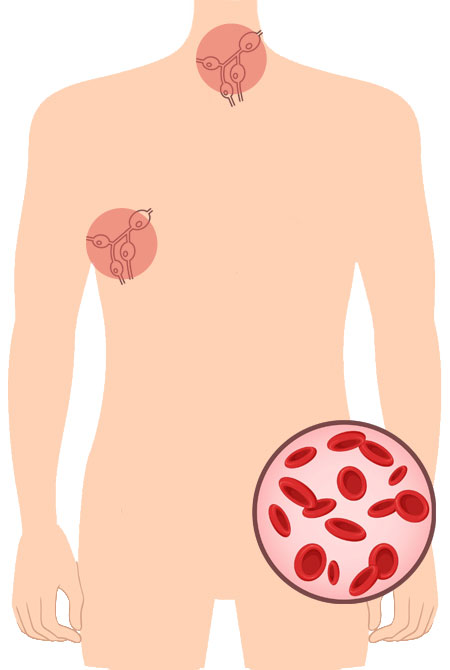 torso umano con 3 aree di linfonodi