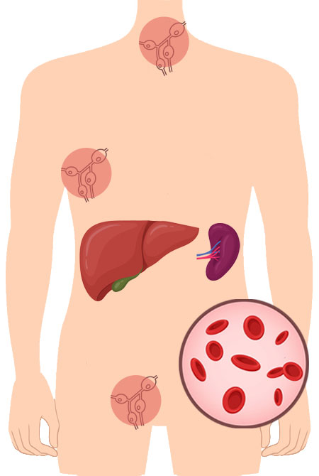 torso umano con linfonodi, fegato e milza; illustrazione anemia moderata