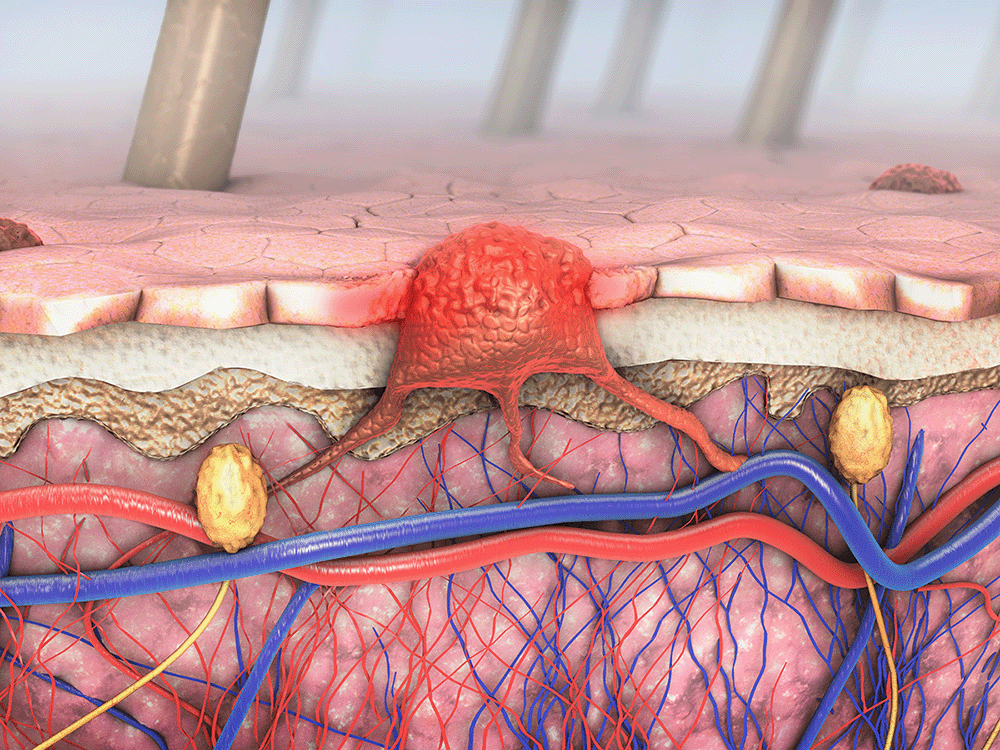 Hidradenitis Supurativa Hidradenitis Supurativa