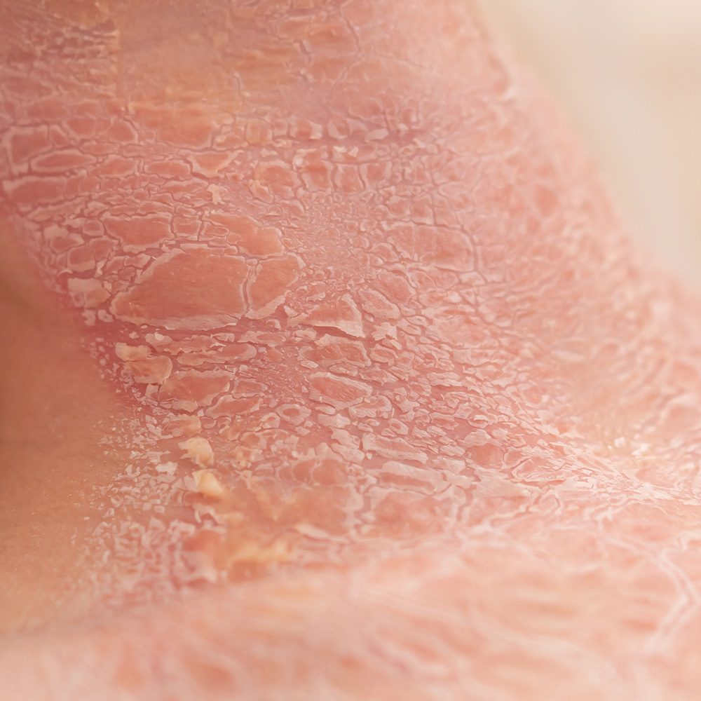 inmuno-Derma