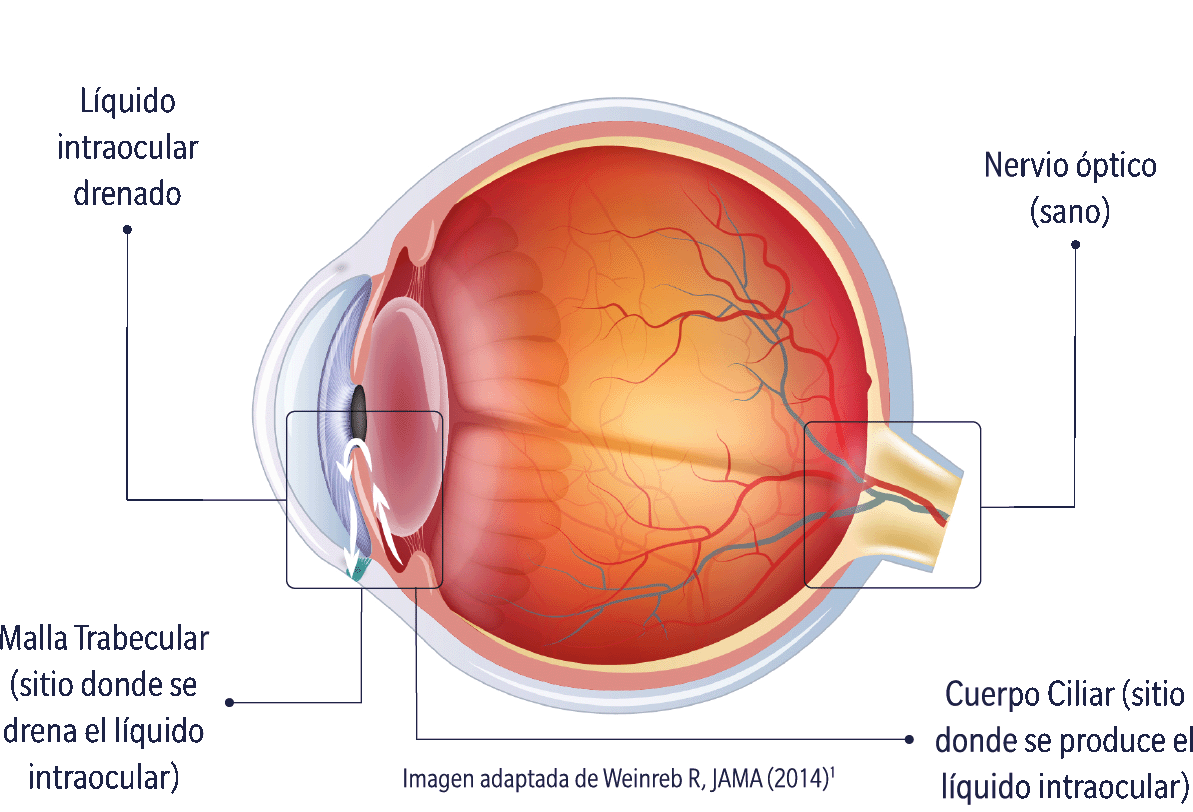 glaucoma1