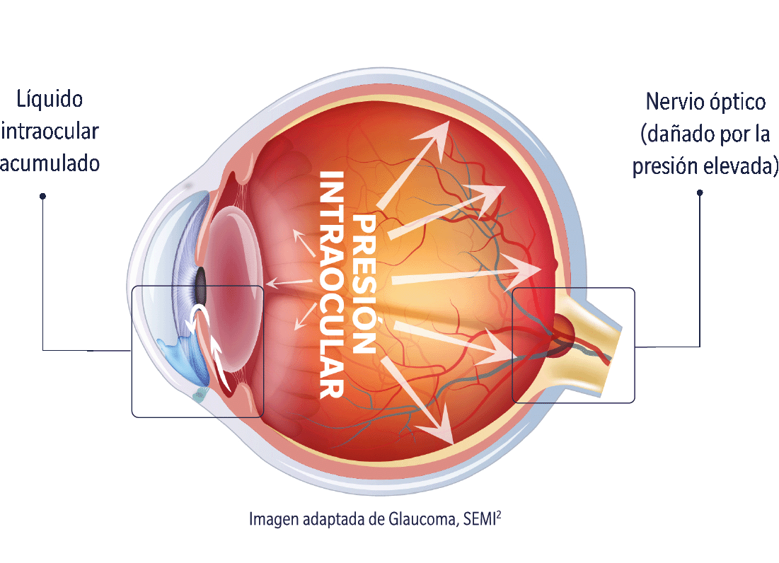 glaucoma1_1