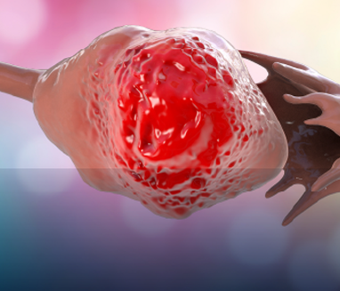 CancerOvario2