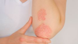 Armbåge med psoriasis
