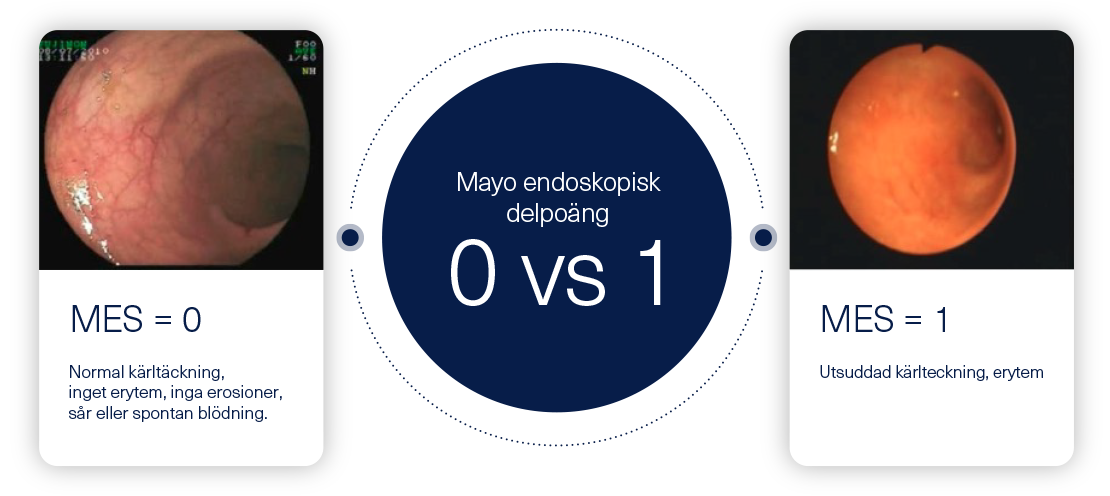 edoskopisk bild av inuti tarm från undersökning av tarm