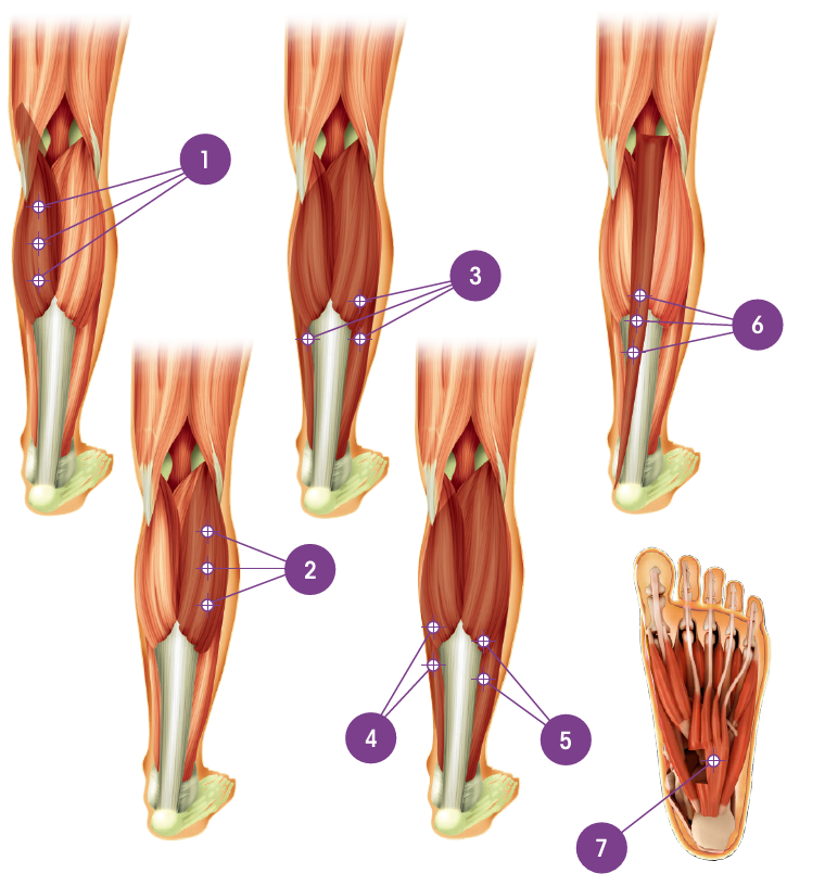 Illustation av injektionsställen i gastrocemius