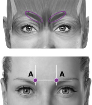 Kvinnas ansikte med markerade injektionsställen
