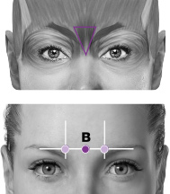 Kvinnas ansikte med markerade injektionsställen