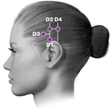 Kvinnas ansikte i profil med markerade injektionsställen