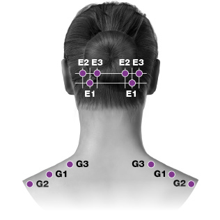 Kvinnas nacke och bakhuvud med markerade injektionsställen