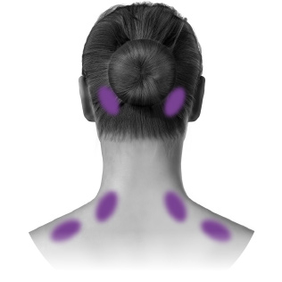 Kvinnas nacke och bakhuvud med markerade injektionsställen