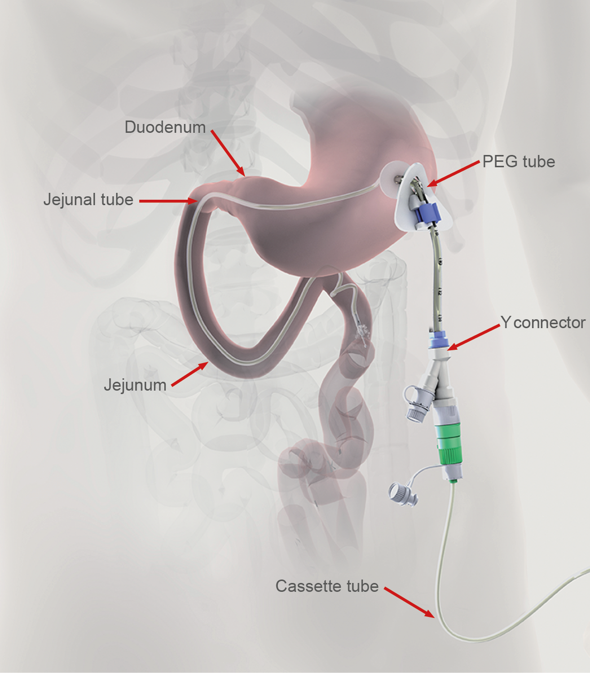 Patient Experience Duodopa® (levodopa/carbidopa intestinal gel)
